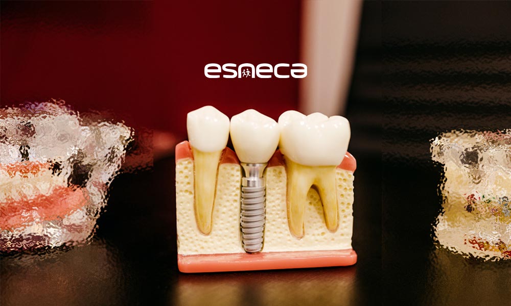 Cosa sono e come funzionano gli Impianti Dentali?